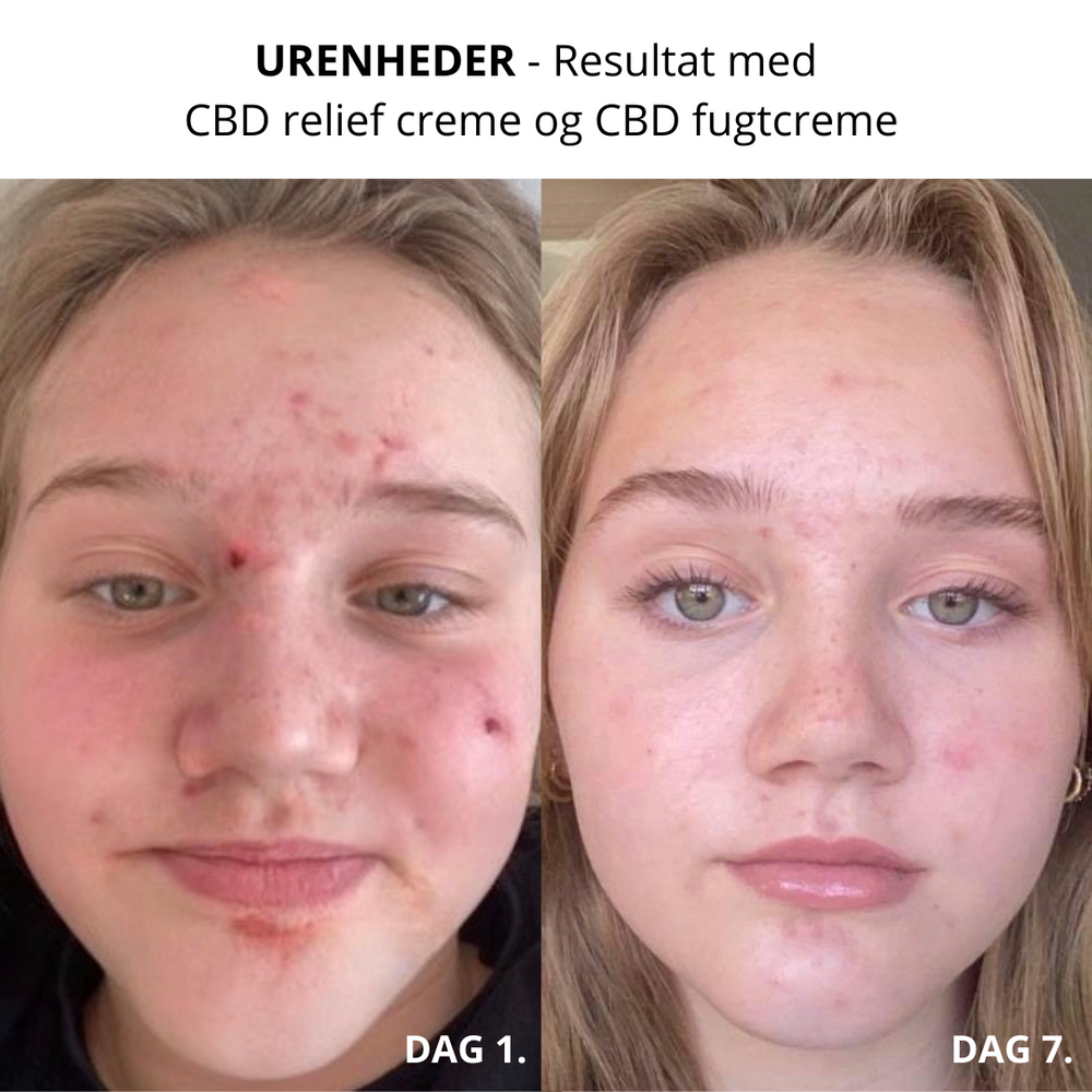 LIV SKINCARE - Rabatpakke til urenheder (velegnet til teenageren)