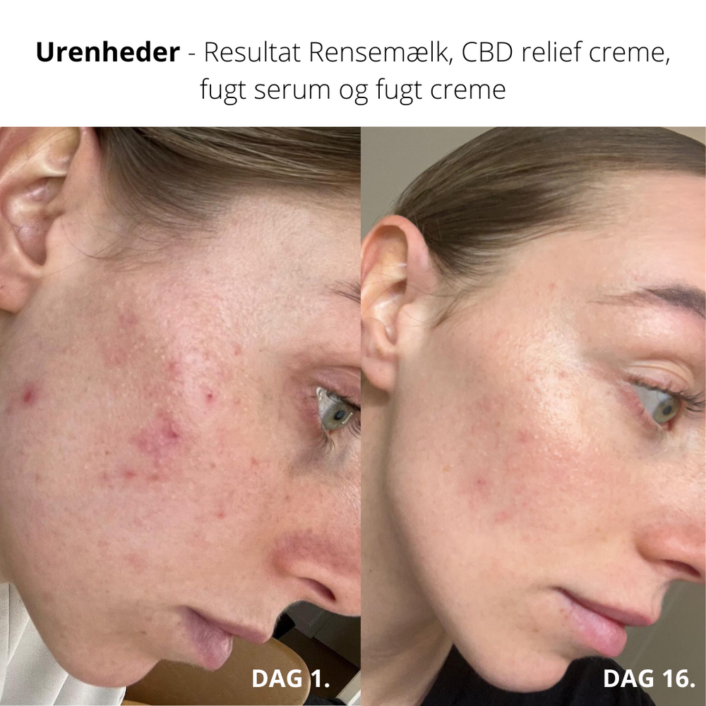 LIV SKINCARE - Rabatpakke til hudproblemer og uren hud