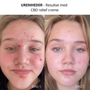 
            
                Load image into Gallery viewer, naturlig acne creme
            
        