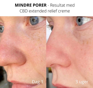 behandling for mindre porer i huden 